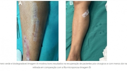 Estudo do HC da UFPE comprova eficácia de curativo pós-cirúrgico produzido a partir da cana-de-açúcar